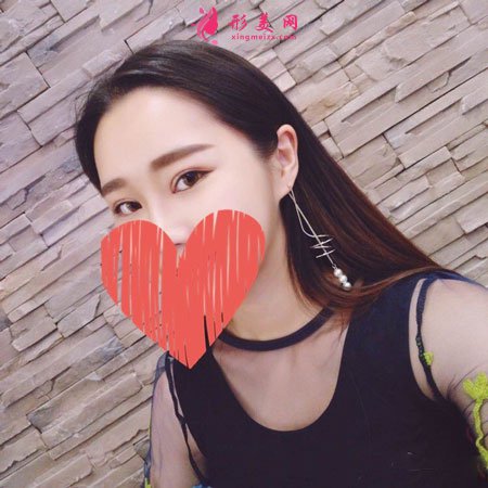 北京八大處楊明勇做雙眼皮修復(fù)手術(shù)前