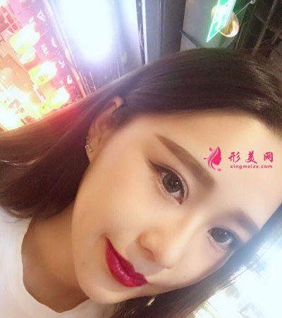 北京八大處楊明勇做雙眼皮修復(fù)手術(shù)后