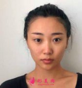 北京沃爾劉彥軍隆鼻怎么樣？案例兩個月效果展示
