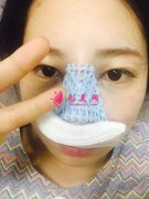 長沙美萊整形醫(yī)院潘衛(wèi)峰院長做的隆鼻效果公開，手術(shù)日記分享