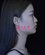 南京美萊美容醫(yī)院磨骨效果圖對比，術(shù)后線條流暢凸顯高級