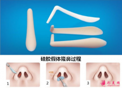 假體隆鼻術(shù)后還要更換嗎？