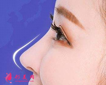 自體軟骨隆鼻后還能取出嗎