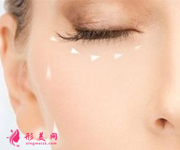 做手術(shù)祛眼袋會(huì)有疤痕嗎