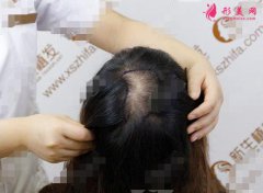 北京新生植發(fā)醫(yī)院頭頂加密植發(fā)8個(gè)月效果圖,前后對(duì)比圖分享