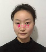 重慶時(shí)光整形美容醫(yī)院削骨術(shù)后效果對(duì)比圖分享