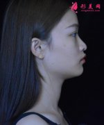 北京沃爾整形美容醫(yī)院磨骨術(shù)后效果，這款小V臉是你喜歡的嗎？