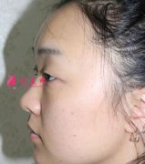 四川友誼整形美容醫(yī)院隆鼻怎么樣？術(shù)后效果對比