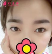 浙醫(yī)二院整形科割雙眼皮效果怎樣?術(shù)后效果一覽~