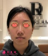 重慶華美張國強隆鼻怎么樣？術(shù)后案例一覽