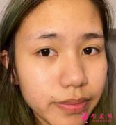 西京醫(yī)院隆鼻怎么樣？術(shù)后效果你有驚艷到嗎？