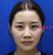 鄭大二附院雙眼皮怎么樣？真實(shí)案例這效果你心動(dòng)嗎？