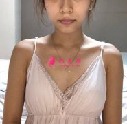 廣州南方醫(yī)院隆胸怎么樣？術后效果反饋！