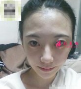 上海百達(dá)麗整形醫(yī)院沈國(guó)雄脂肪填充前后恢復(fù)對(duì)比圖
