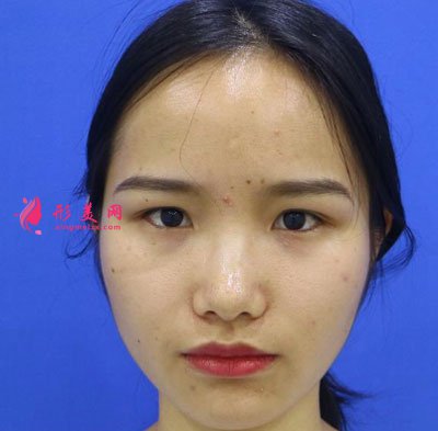 廈門安黛美醫(yī)療整形美容切開雙眼皮案例
