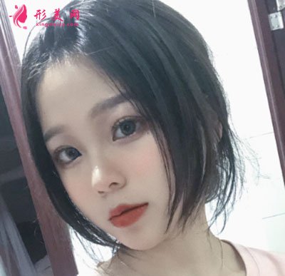 廈門安黛美醫(yī)療整形美容切開雙眼皮案例
