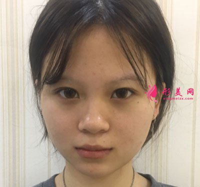 廈門安黛美醫(yī)療整形美容切開雙眼皮案例