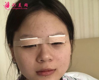廈門安黛美醫(yī)療整形美容切開雙眼皮案例