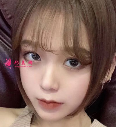 廈門安黛美醫(yī)療整形美容切開雙眼皮案例