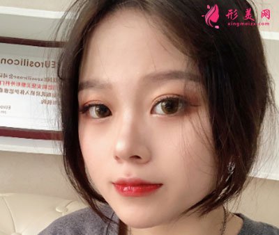 廈門安黛美醫(yī)療整形美容切開雙眼皮案例