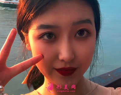 寧波靜港整形自體脂肪面部填充案例