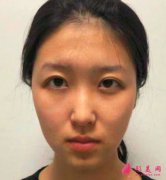 寧波靜港整形自體脂肪面部填充真人案例分享！