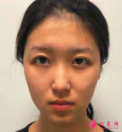 寧波靜港整形自體脂肪面部填充案例