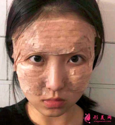 寧波靜港整形自體脂肪面部填充案例