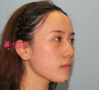 寧波薇琳醫(yī)療美容醫(yī)院肋軟骨隆鼻怎么樣？