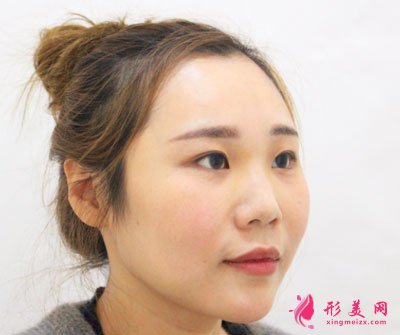 天津圣韓美醫(yī)療美容鼻部多項案例