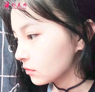 天津維美醫(yī)療美容醫(yī)院鼻部多項案例
