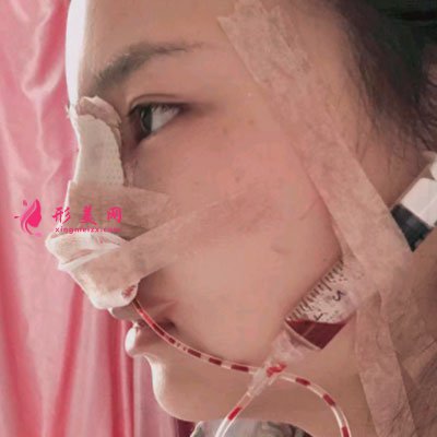 天津維美醫(yī)療美容醫(yī)院鼻部多項案例