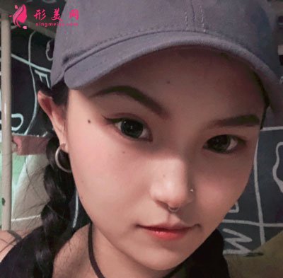 天津維美醫(yī)療美容醫(yī)院鼻部多項案例