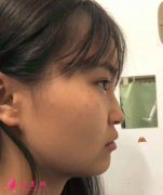 天津維美醫(yī)療美容醫(yī)院做的鼻綜合，術后50天鼻子又翹又挺