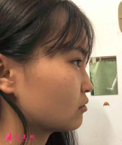 天津維美醫(yī)療美容醫(yī)院鼻部多項案例