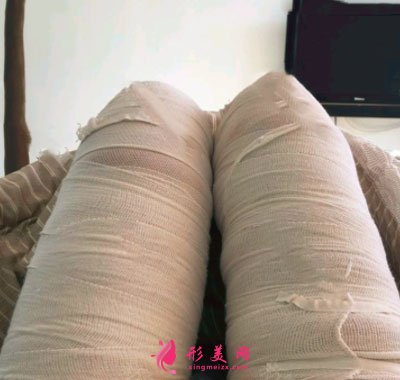 天津維美醫(yī)療美容醫(yī)院做的吸脂瘦大腿