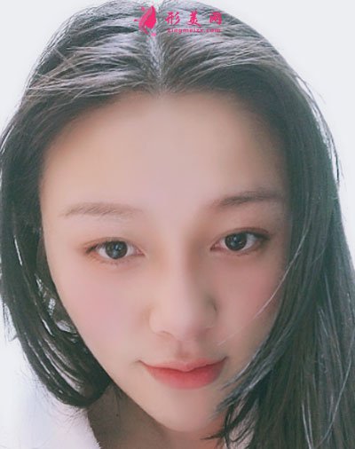昆明藝星醫(yī)療美容醫(yī)院鼻部多項案例