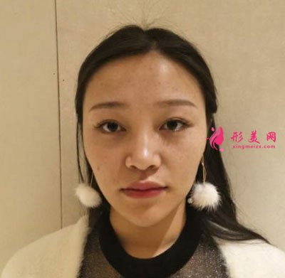 昆明藝星醫(yī)療美容醫(yī)院鼻部多項案例