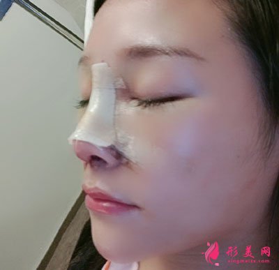 昆明藝星醫(yī)療美容醫(yī)院鼻部多項案例