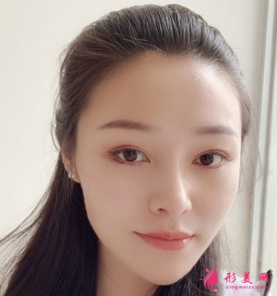 昆明藝星醫(yī)療美容醫(yī)院鼻部多項案例