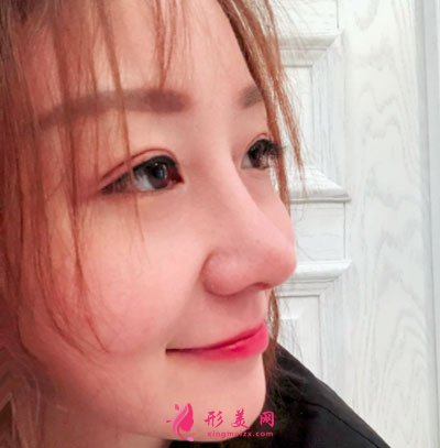 北京美萊醫(yī)療美容醫(yī)院鼻部多項(xiàng)手術(shù)案例
