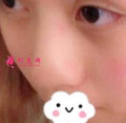 北京301郭伶俐做鼻子好不好？術(shù)后一年恢復(fù)記錄