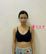 北京黃寺醫(yī)院隆胸怎么樣?權(quán)威醫(yī)院做的效果就是不一樣
