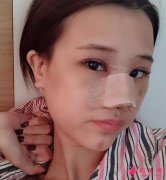 浙醫(yī)二院隆鼻怎么樣？真人案例在線反饋這效果你i了嗎？