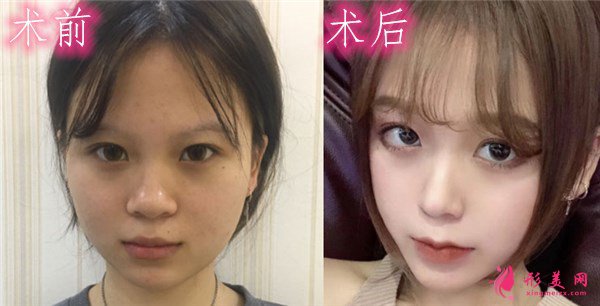 廈門安黛美醫(yī)療美容醫(yī)院張俠醫(yī)生案例
