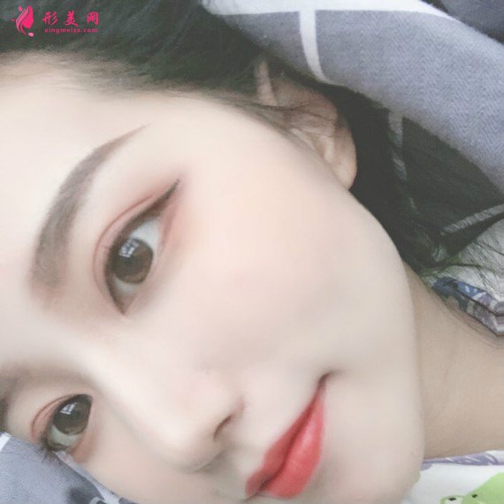 長沙美容院自體脂肪面部填充和假體豐下巴整形日記 長沙美容院自體脂肪面部填充和假體豐下巴整形日記