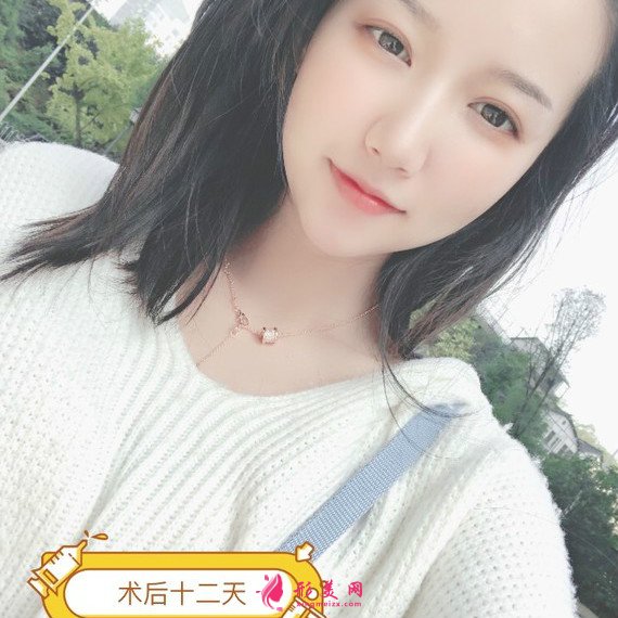 長沙美容院自體脂肪面部填充和假體豐下巴整形日記 長沙美容院自體脂肪面部填充和假體豐下巴整形日記