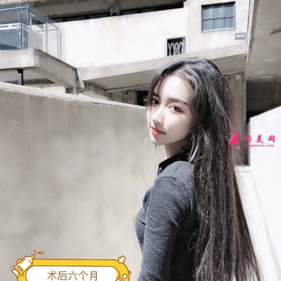 長沙美容院自體脂肪面部填充和假體豐下巴整形日記 長沙美容院自體脂肪面部填充和假體豐下巴整形日記