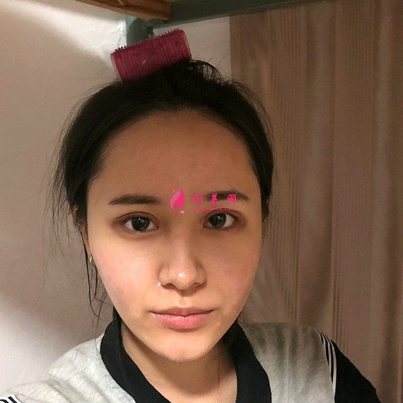 重慶美禪整形醫(yī)院做的全切雙眼皮效果還不錯 重慶美禪整形醫(yī)院做的全切雙眼皮效果還不錯