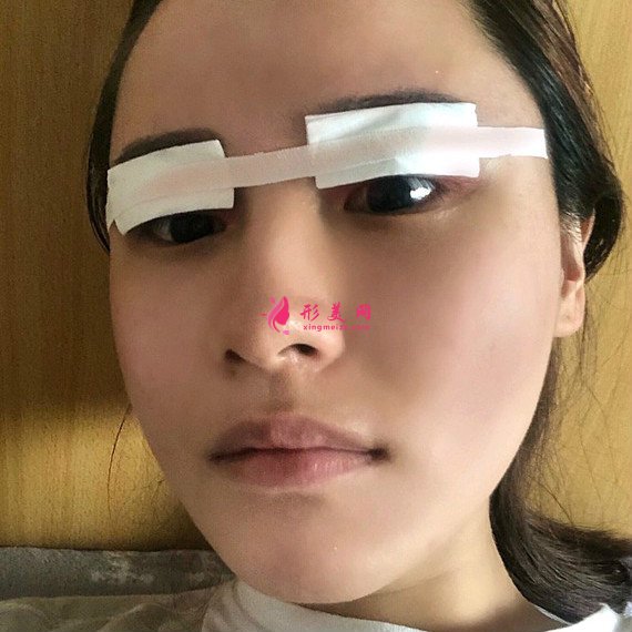 重慶美禪整形醫(yī)院做的全切雙眼皮效果還不錯 重慶美禪整形醫(yī)院做的全切雙眼皮效果還不錯